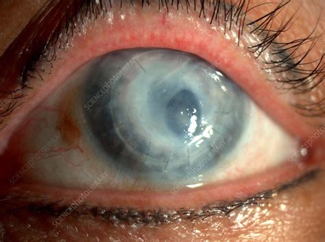 what does a failed corneal graft patient see